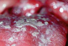 кандидозный стоматит 2 кандидозный стоматит 2