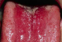 кандидозный стоматит 3 кандидозный стоматит 3