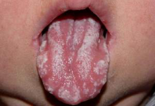 кандидозный стоматит 4 кандидозный стоматит 4