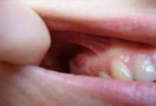 Киста зуба фото 1 Киста зуба фото 1