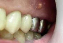 Киста зуба фото 2 Киста зуба фото 2