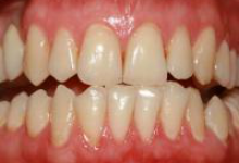 Пародонтит фото 1 Пародонтит фото 1