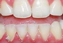 Пародонтит фото 2 Пародонтит фото 2