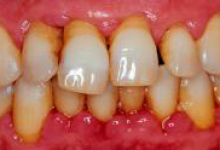 Пародонтит фото 3 Пародонтит фото 3