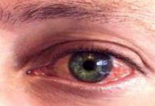 Симптомы коньюктивита у взрослых фото 4