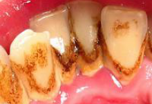 Зубной камень фото 1 Зубной камень фото 1