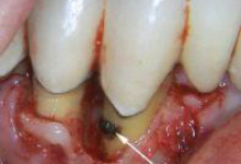 Зубной камень фото 2 Зубной камень фото 2