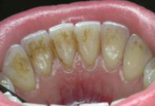 Зубной камень фото 3 Зубной камень фото 3