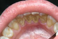 Зубной камень фото 4 Зубной камень фото 4